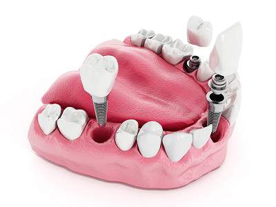Зубные импланты цены
