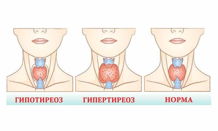 Щитовидная железа гипотиреоз. Тиреоидный гипотиреоз. Симптомы гипертиреоза щитовидной железы у детей. Норма гипертиреоза и гипотиреоза. Патология щитовидной железы. Гипотиреоз.